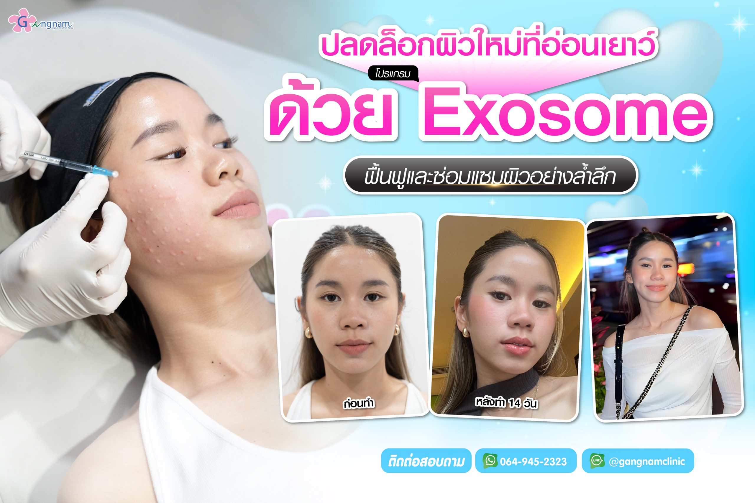 exosomeปลดล็อกผิวใหม่อ่อนเยาว์