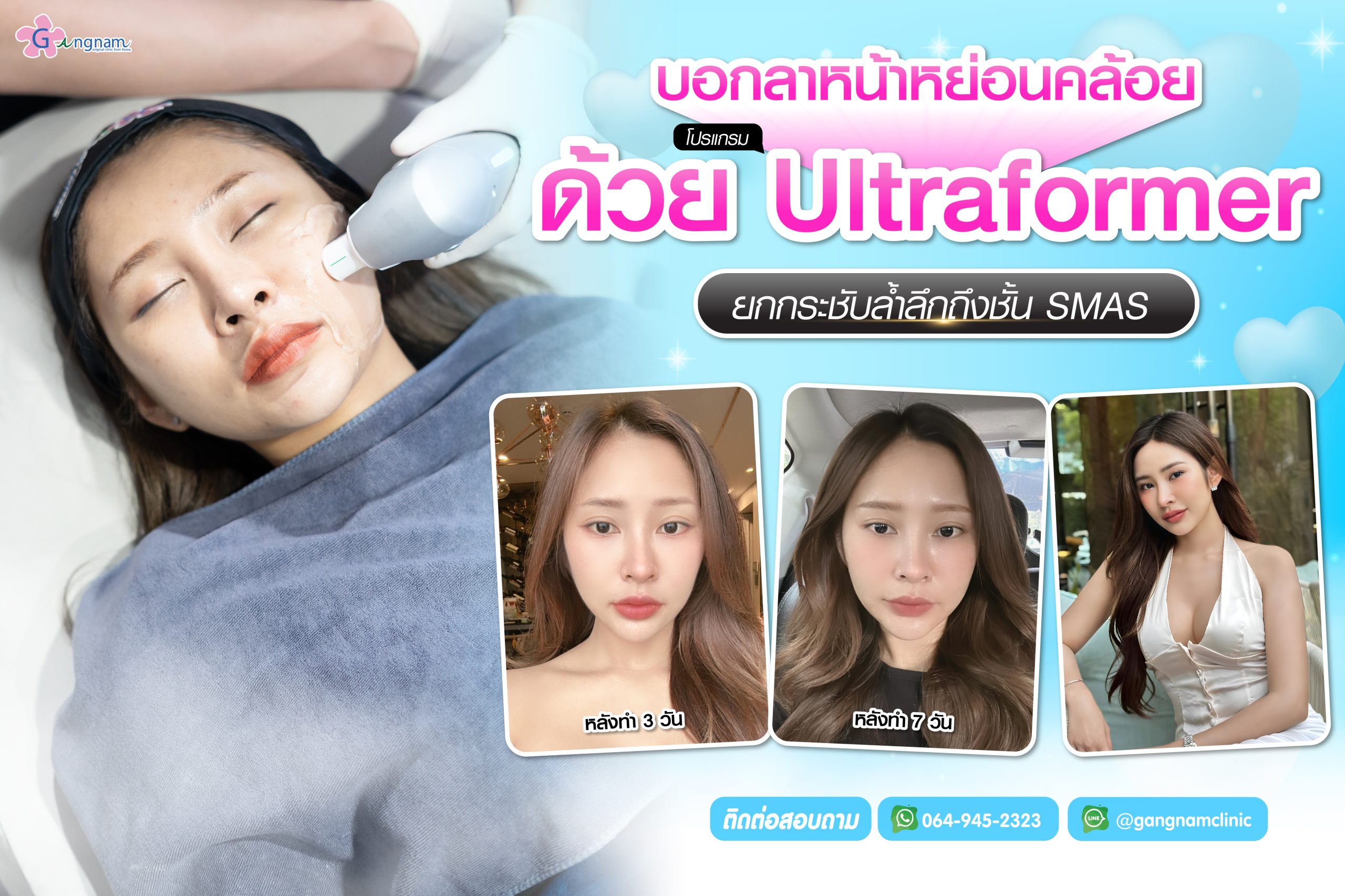 ultraformerบอกลาหน้าหย่อนคล้อย