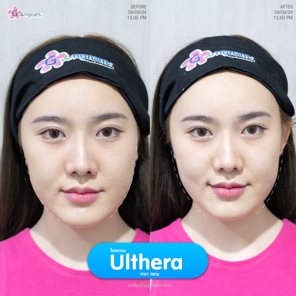 ulthera2