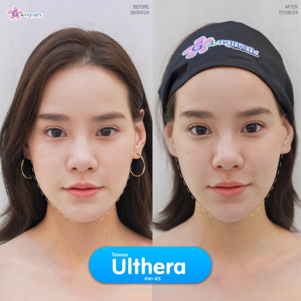 ulthera3